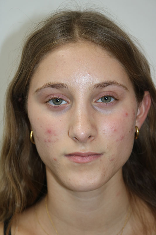 Rhinoplasty Before & After Image