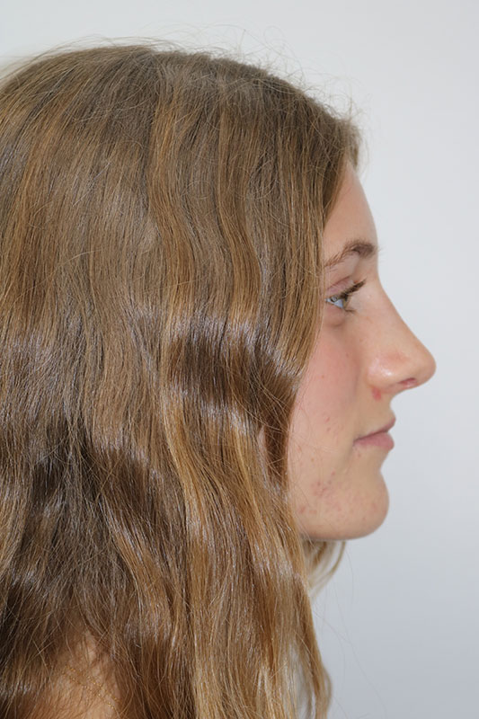 Rhinoplasty Before & After Image