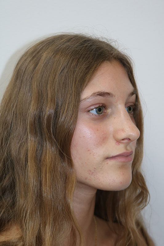 Rhinoplasty Before & After Image