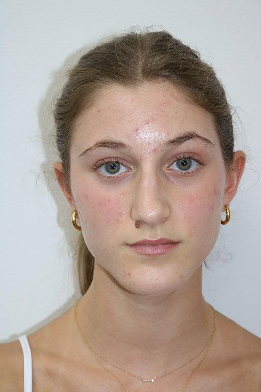 Rhinoplasty Before & After Image