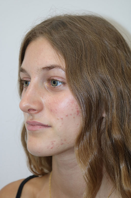 Rhinoplasty Before & After Image