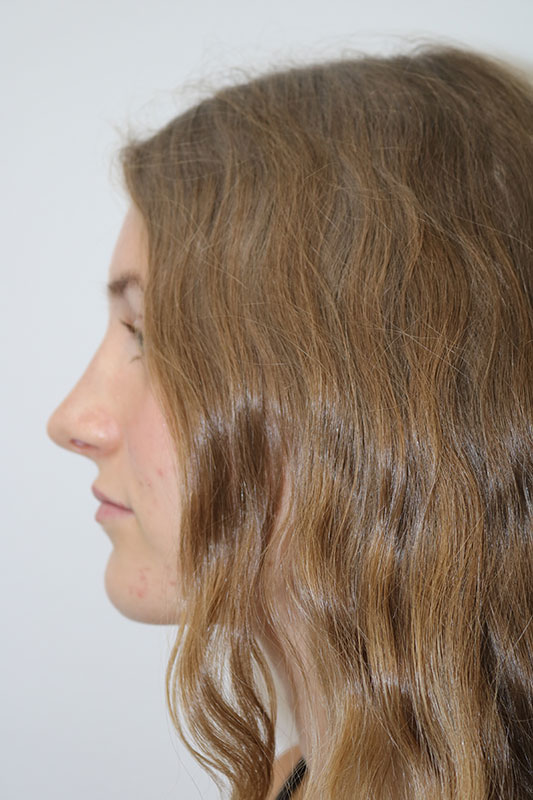 Rhinoplasty Before & After Image