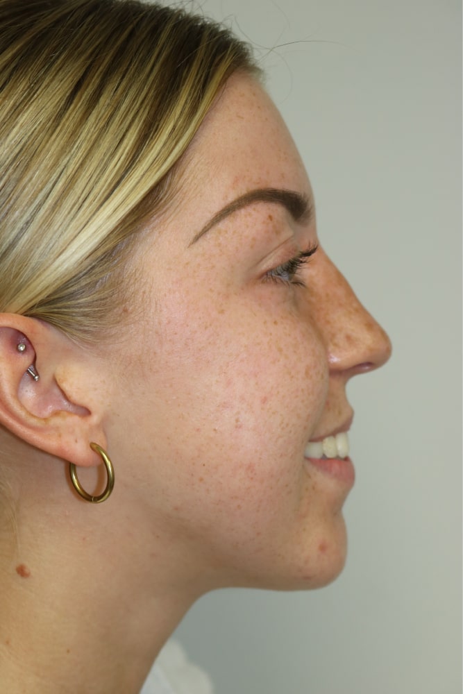 Rhinoplasty Before & After Image