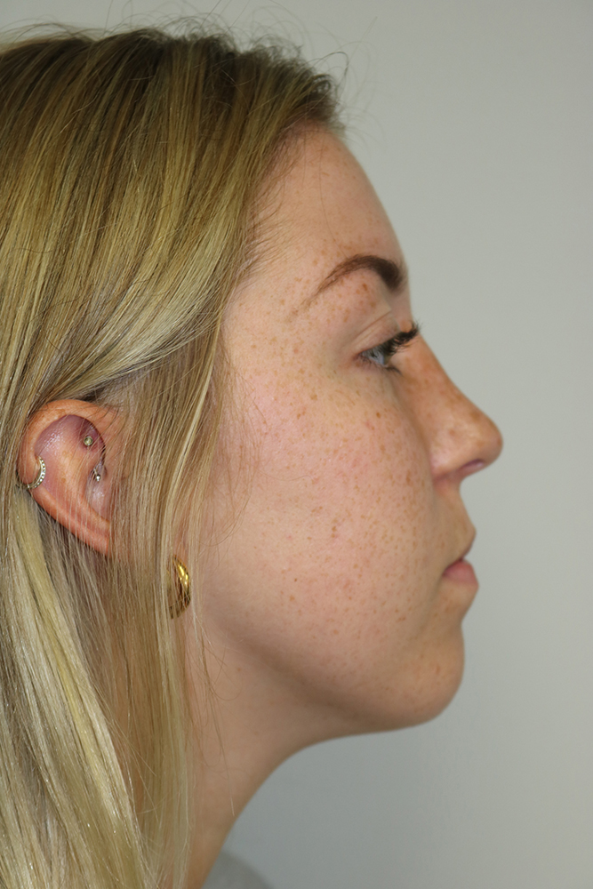 Rhinoplasty Before & After Image