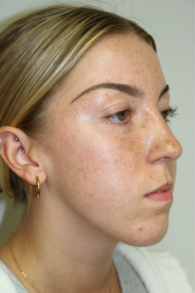 Rhinoplasty Before & After Image