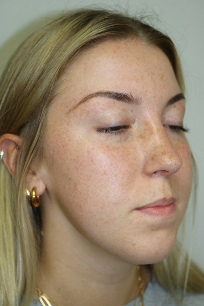 Rhinoplasty Before & After Image