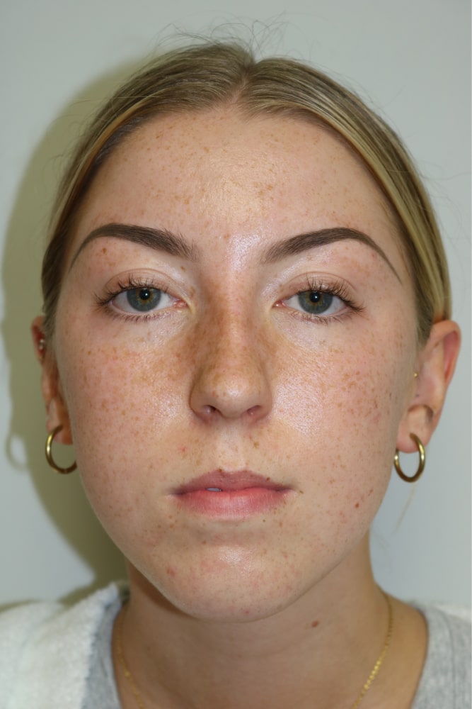 Rhinoplasty Before & After Image