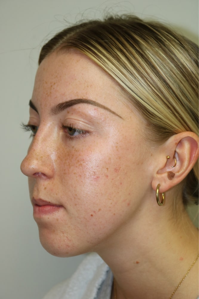 Rhinoplasty Before & After Image