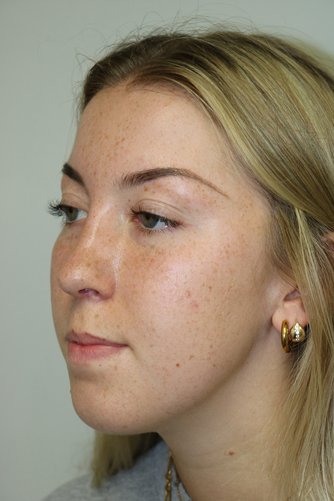 Rhinoplasty Before & After Image