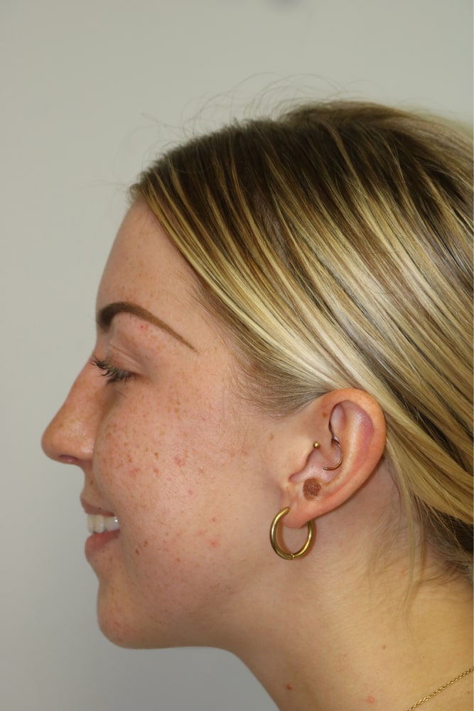 Rhinoplasty Before & After Image