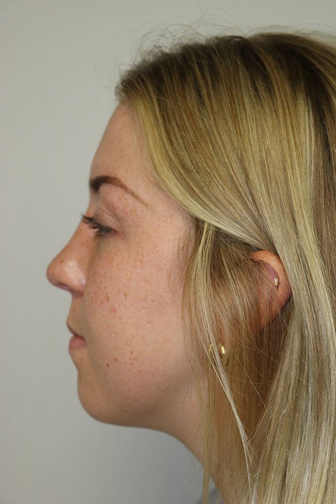 Rhinoplasty Before & After Image