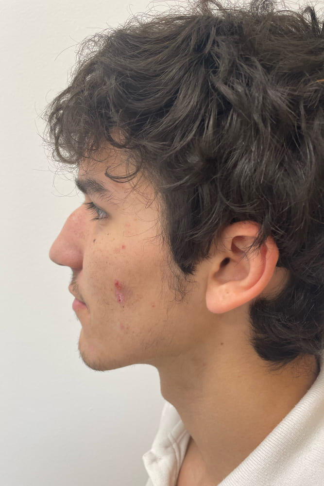 Rhinoplasty Before & After Image