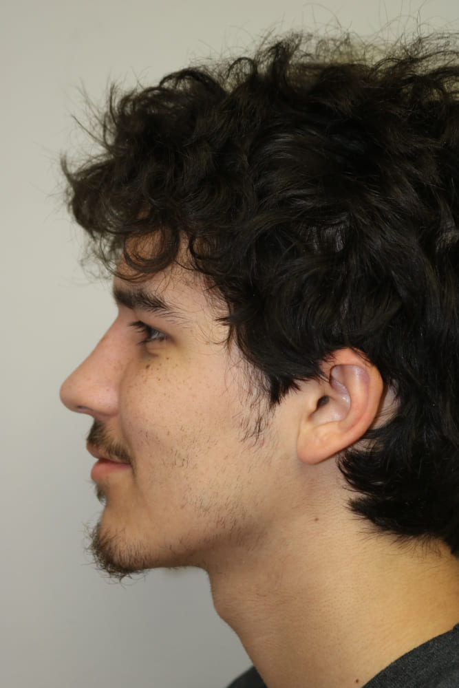 Rhinoplasty Before & After Image