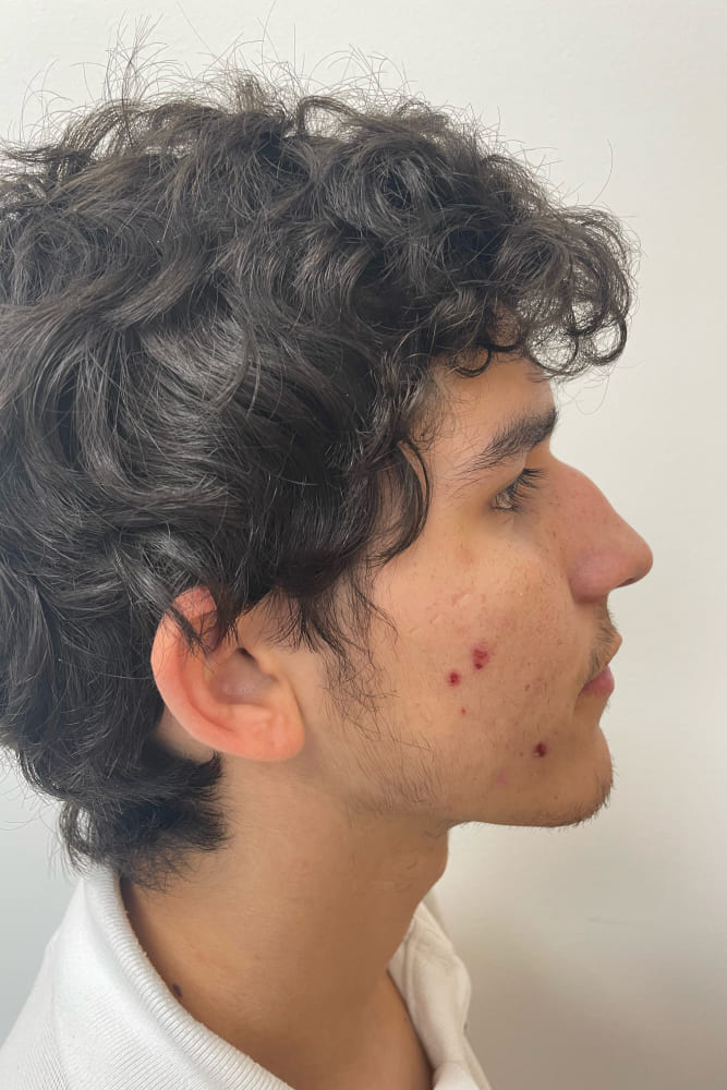 Rhinoplasty Before & After Image