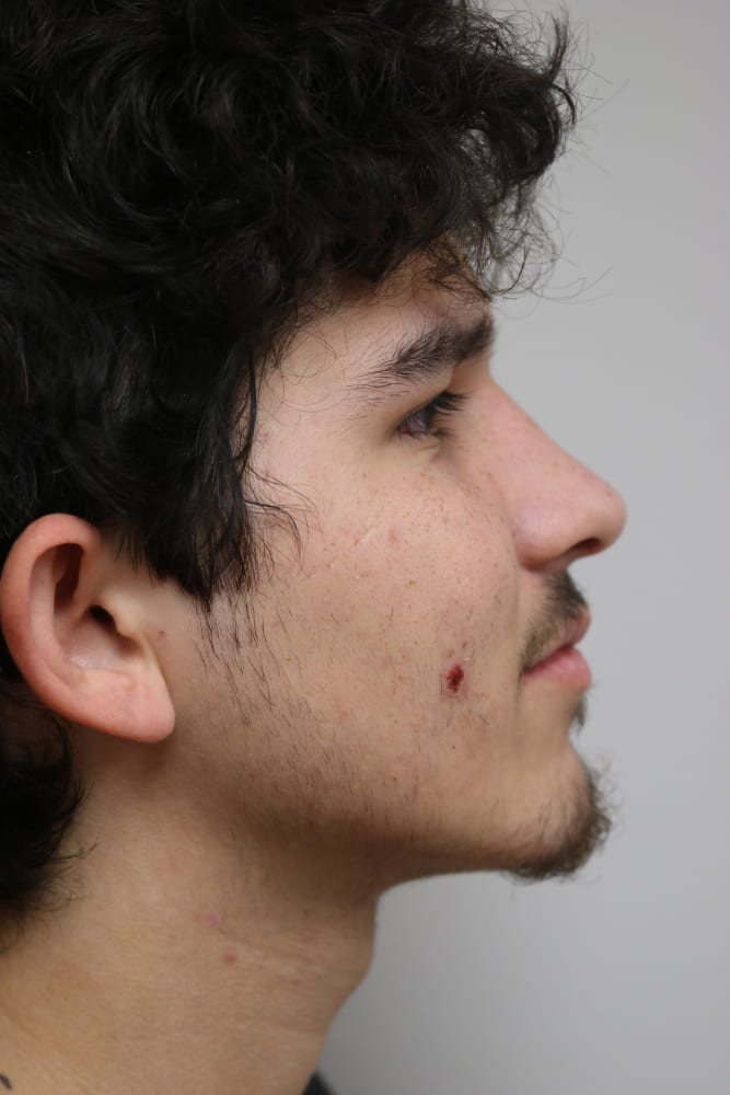 Rhinoplasty Before & After Image