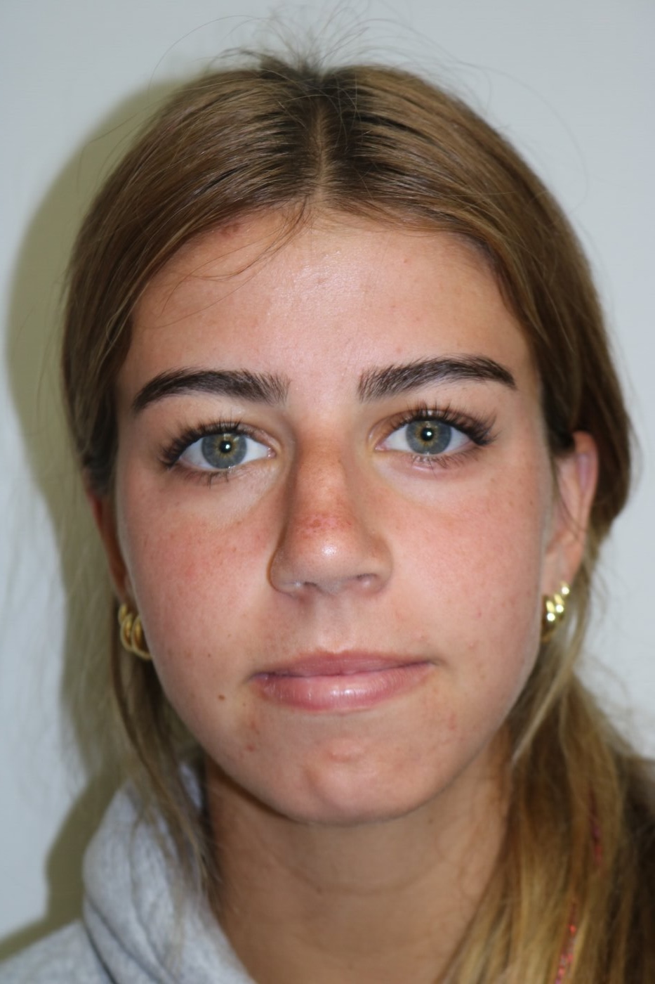 Rhinoplasty Before & After