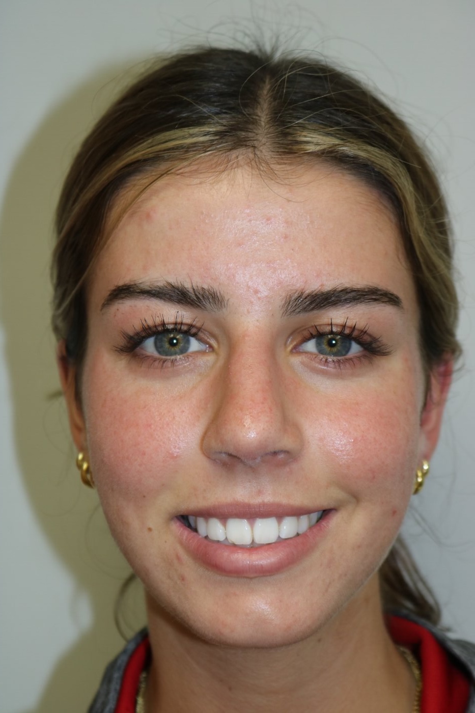 Rhinoplasty Before & After