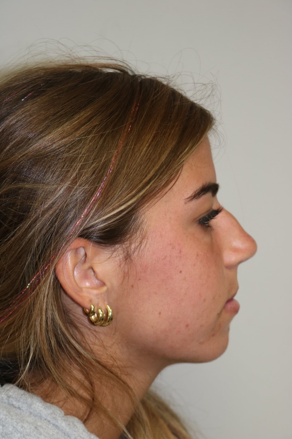 Rhinoplasty Before & After