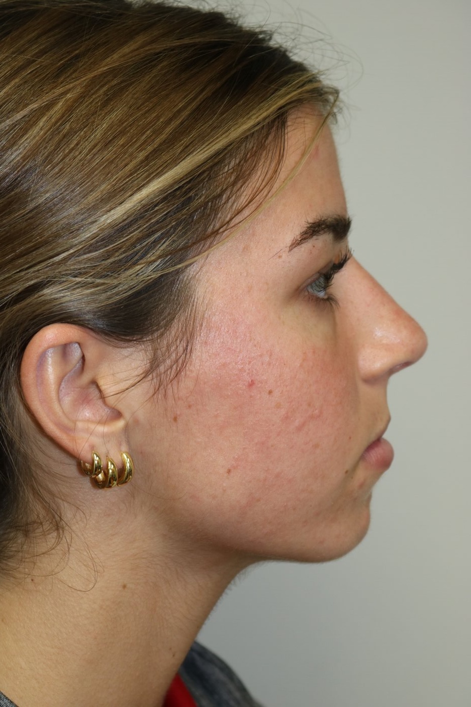Rhinoplasty Before & After