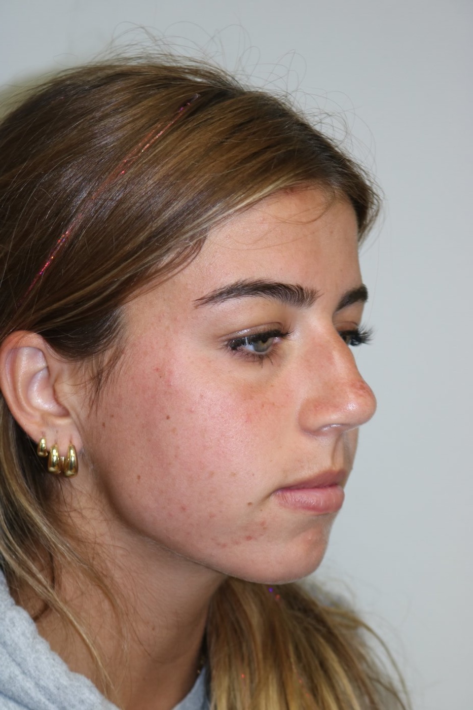 Rhinoplasty Before & After