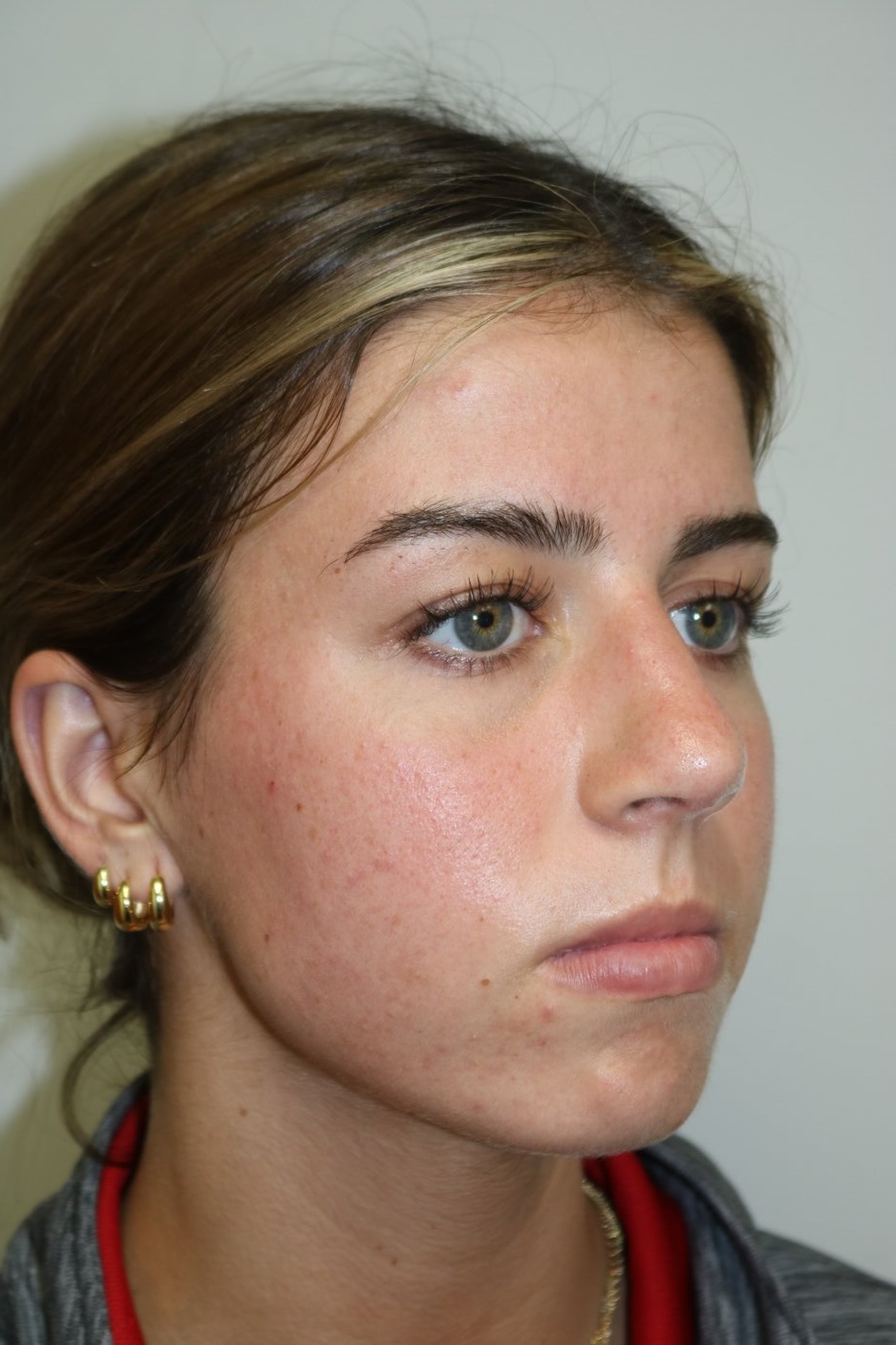 Rhinoplasty Before & After