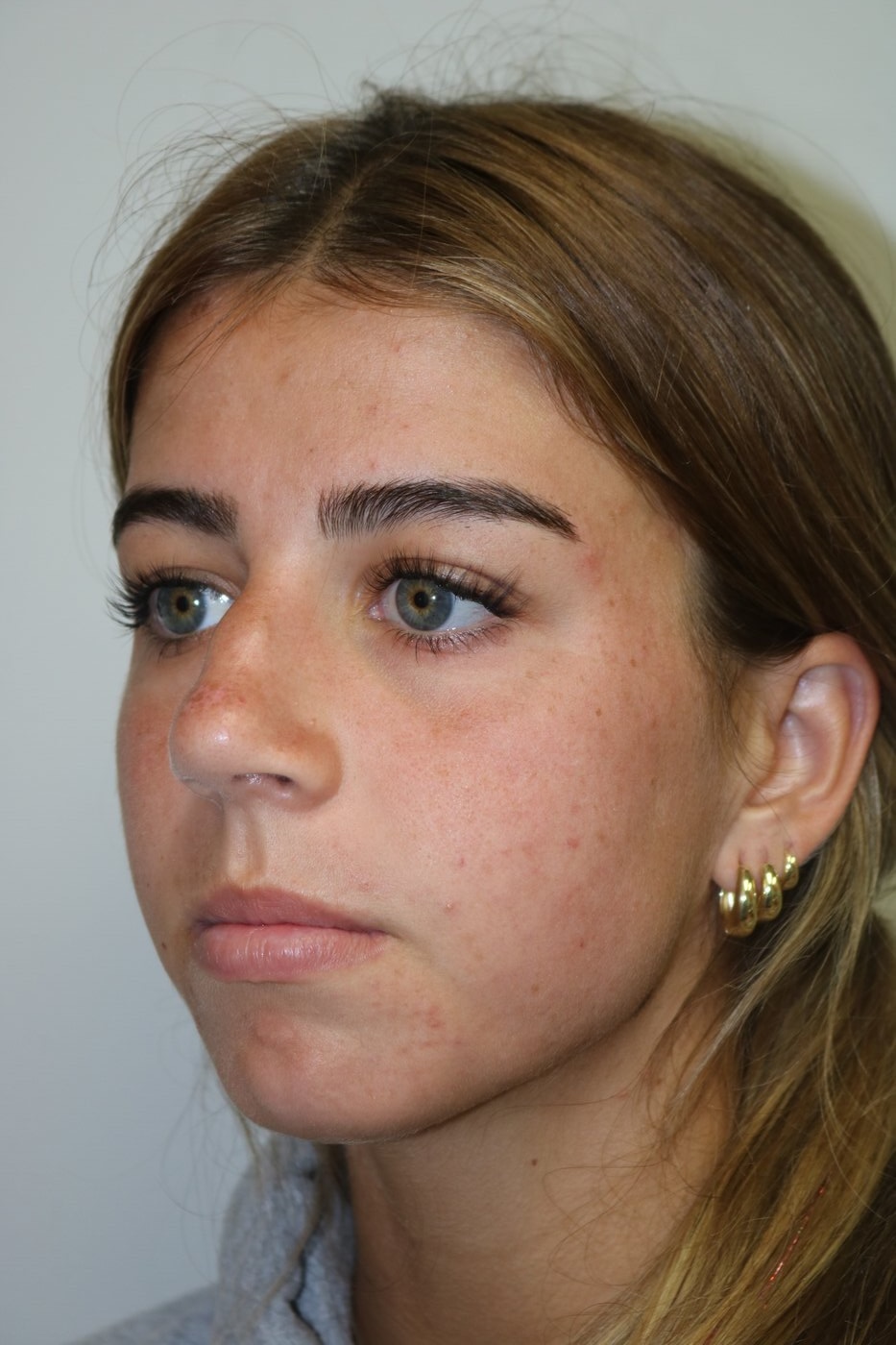 Rhinoplasty Before & After