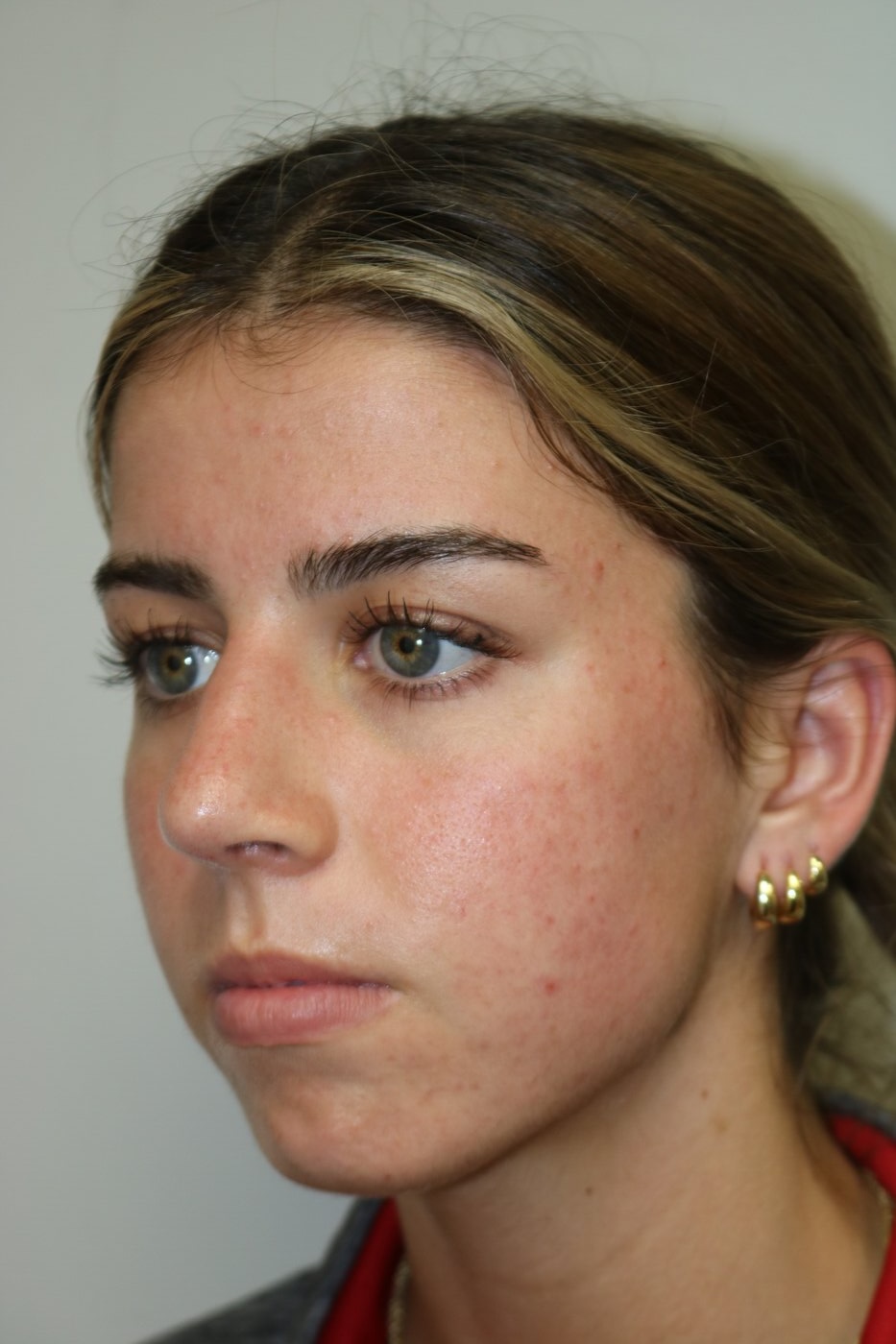 Rhinoplasty Before & After