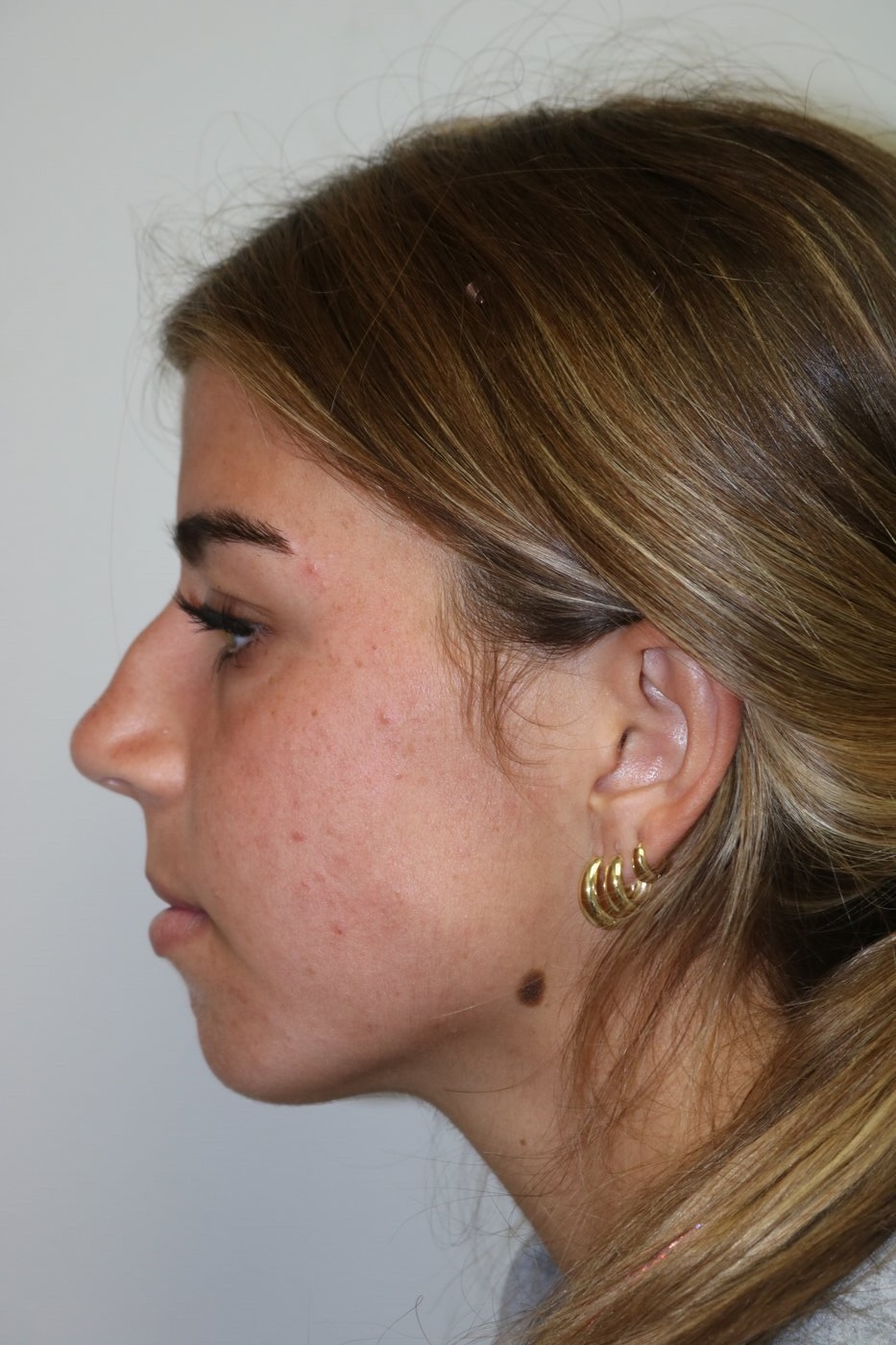 Rhinoplasty Before & After