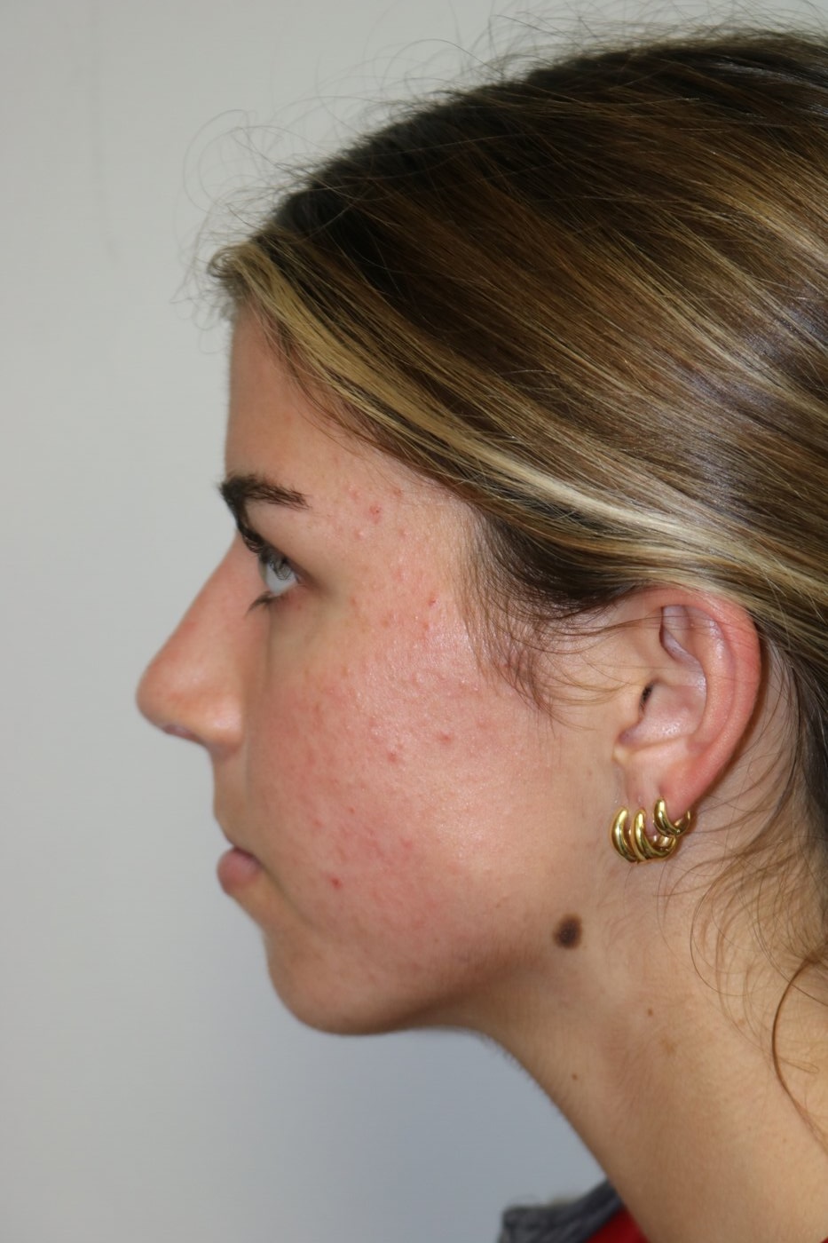 Rhinoplasty Before & After