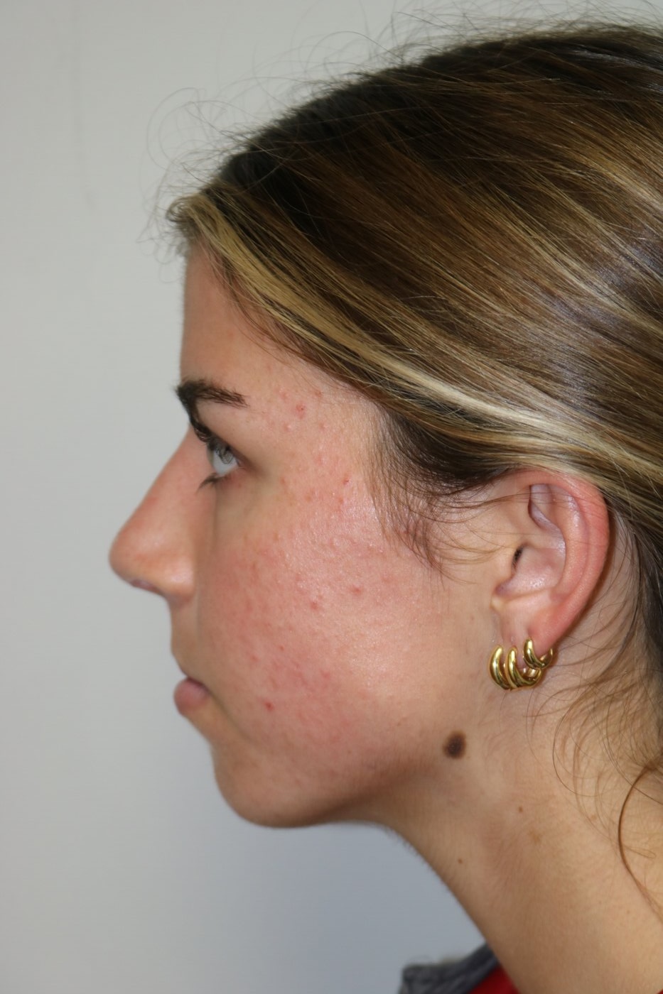 Rhinoplasty Before & After Image