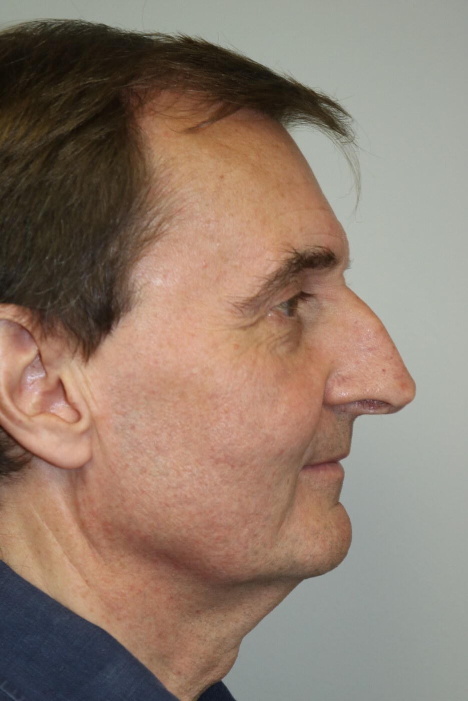 Rhinoplasty Before & After