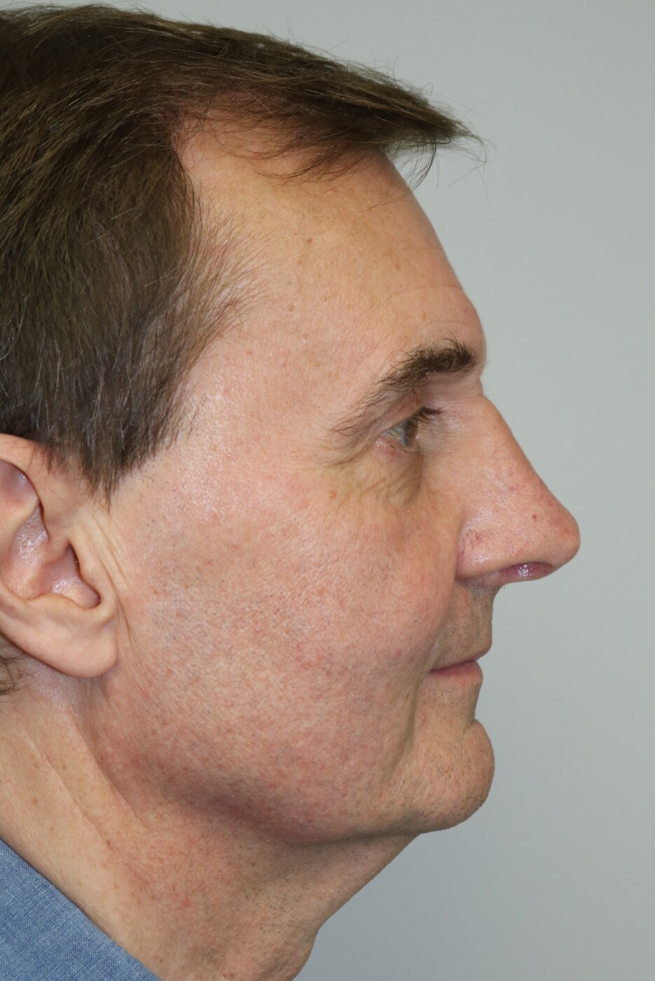 Rhinoplasty Before & After