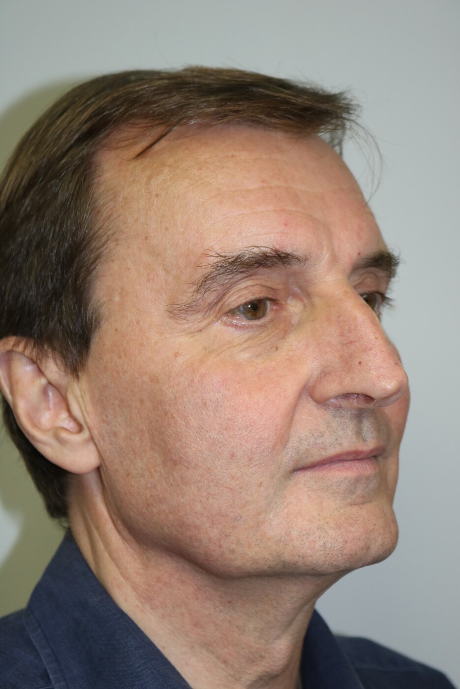 Rhinoplasty Before & After