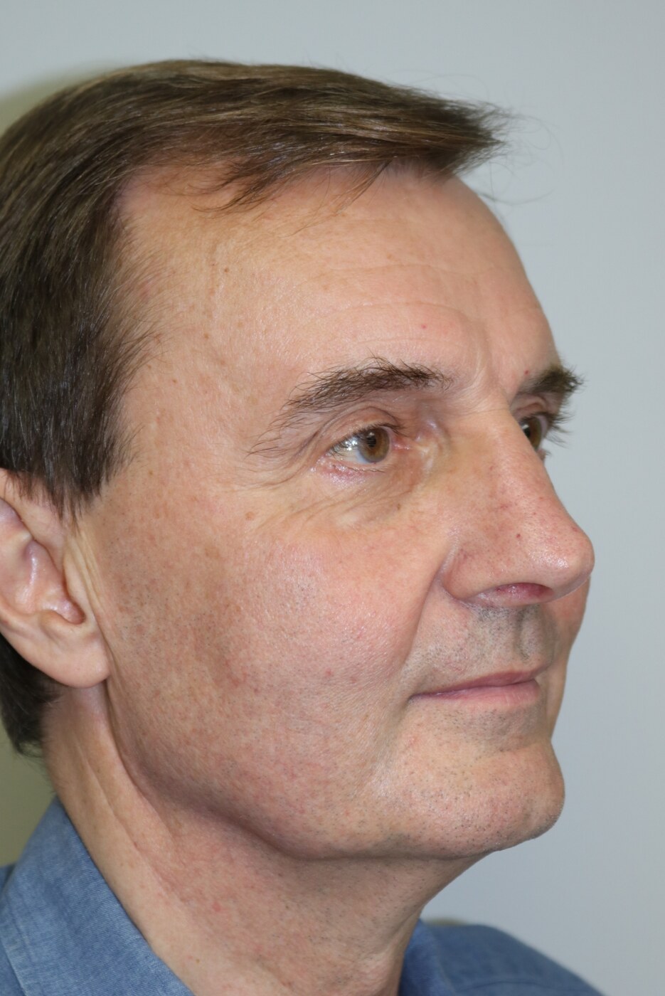 Rhinoplasty Before & After