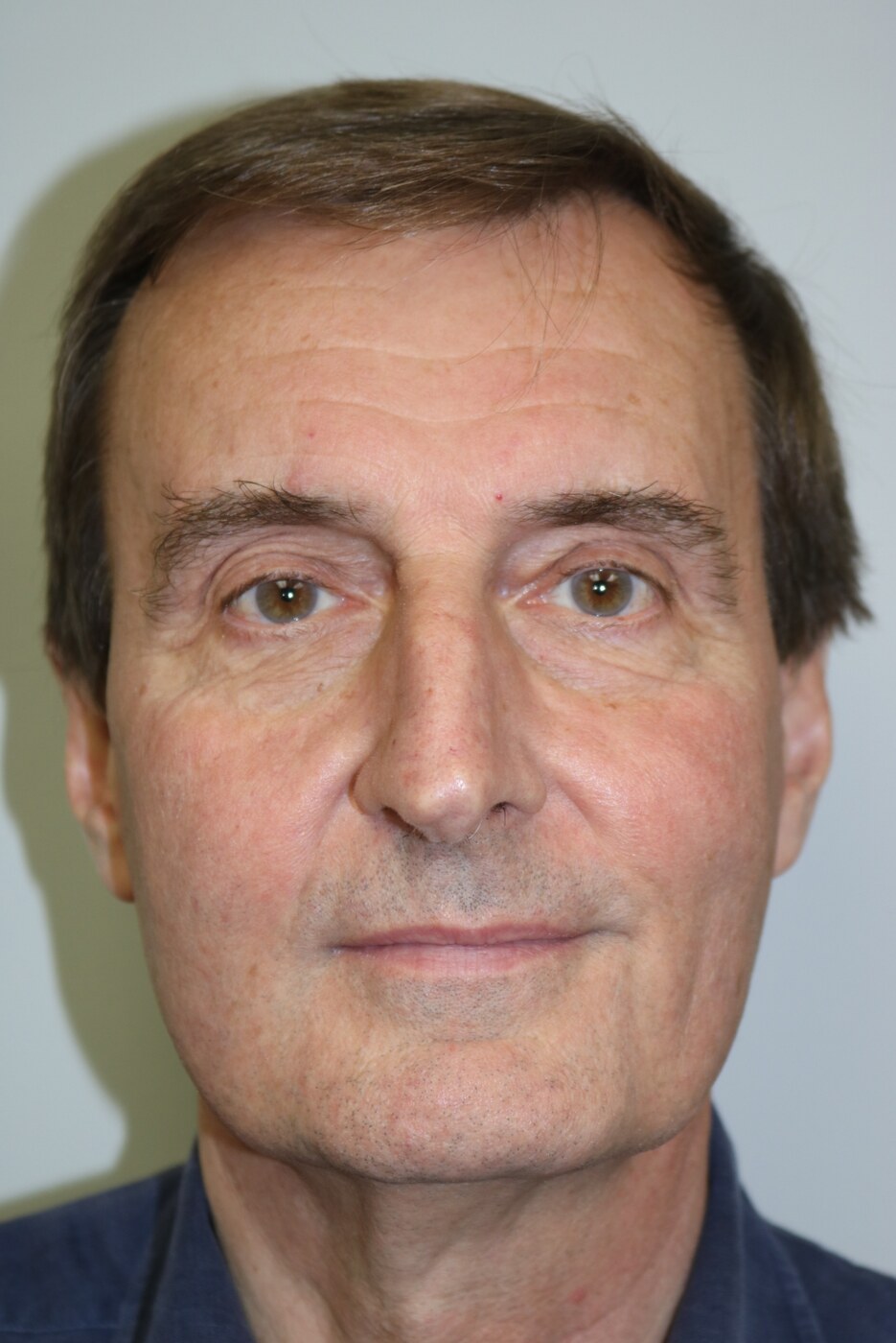 Rhinoplasty Before & After