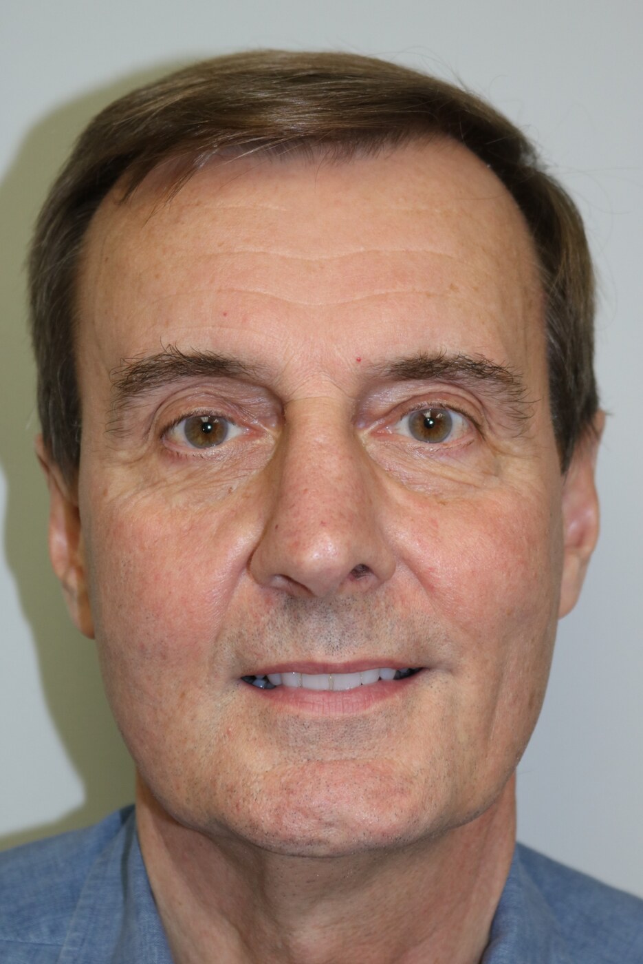 Rhinoplasty Before & After