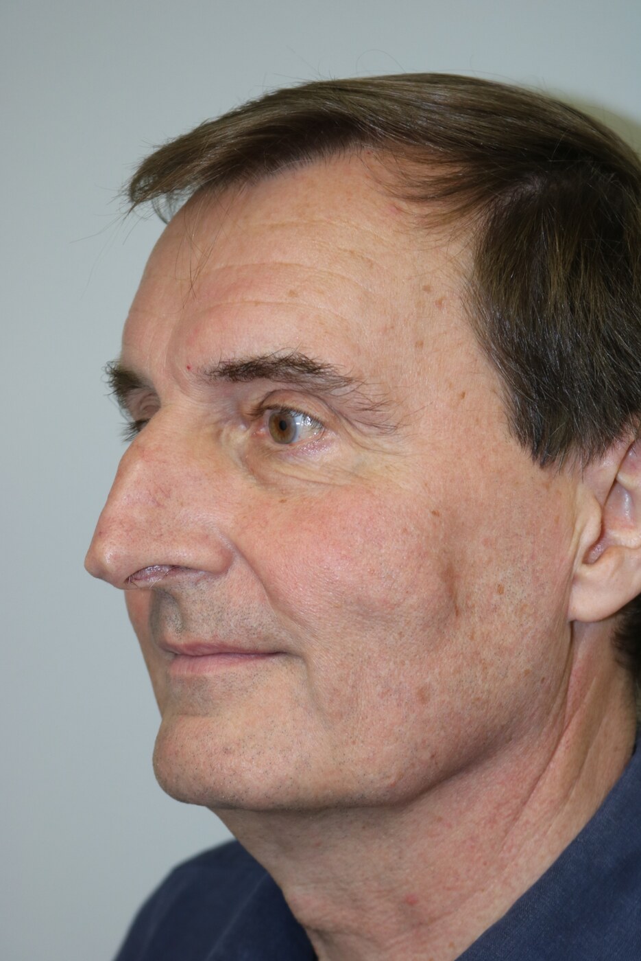 Rhinoplasty Before & After