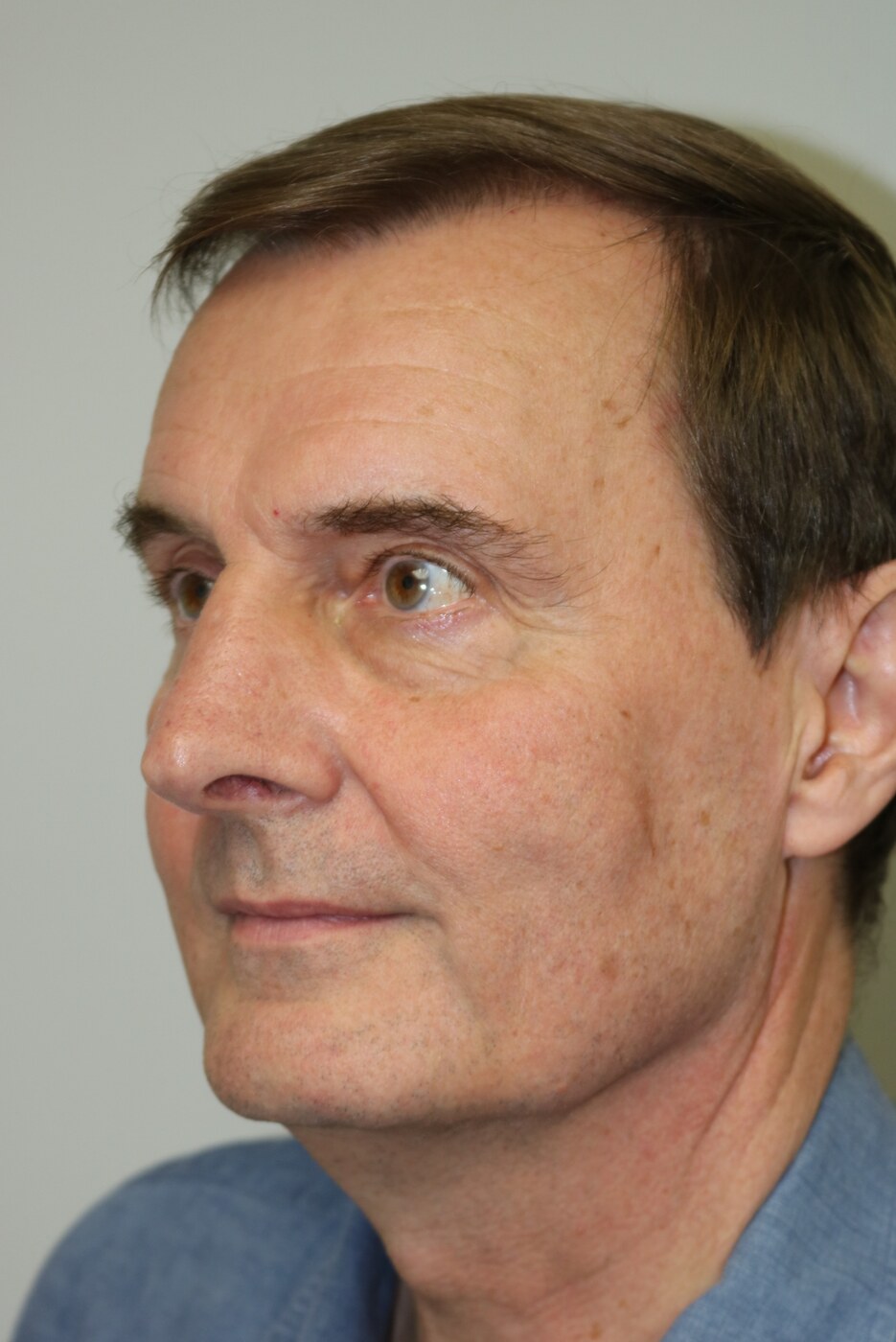 Rhinoplasty Before & After