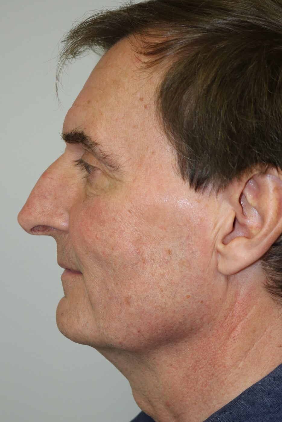 Rhinoplasty Before & After