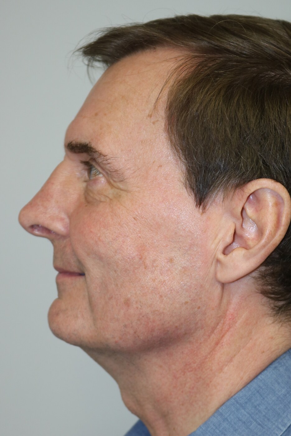 Rhinoplasty Before & After