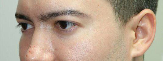 Upper Blepharoplasty Before & After Image