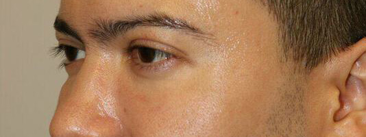 Upper Blepharoplasty Before & After Image