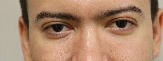 Upper Blepharoplasty Before & After Image