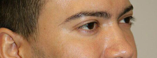 Upper Blepharoplasty Before & After Image