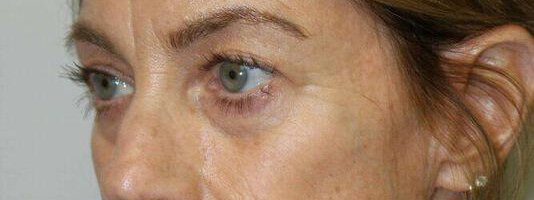 Upper Blepharoplasty Before & After Image