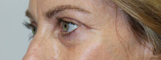 Upper Blepharoplasty Before & After Image