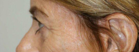 Upper Blepharoplasty Before & After Image