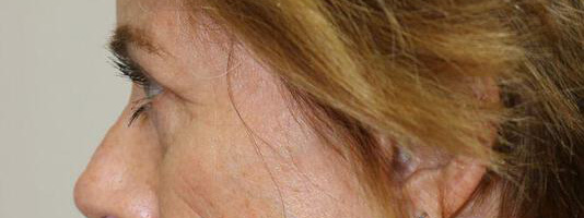 Upper Blepharoplasty Before & After Image