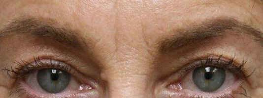 Upper Blepharoplasty Before & After Image