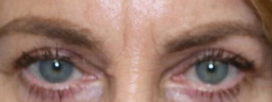 Upper Blepharoplasty Before & After Image